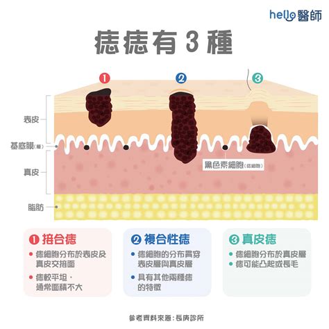 痣 有毛|痣形成的原因？痣長毛、痣變多變大是痣病變？5招判。